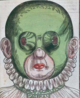 Masque pour traiter un strabisme, Georg Bartisch (1535-1636)